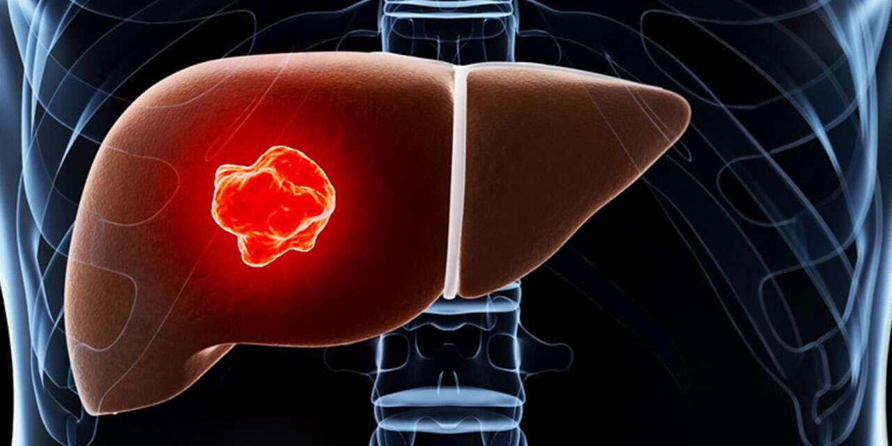 “karacigerdeki-kanserin-kaynagi-baska-organ-olabilir”